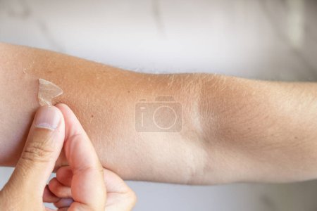Téléchargez les photos : Exfoliation de la peau après coup de soleil. Un homme épluchant sa peau sur son bras. La peau se détache, brûlée. Concept de soins de la peau - en image libre de droit