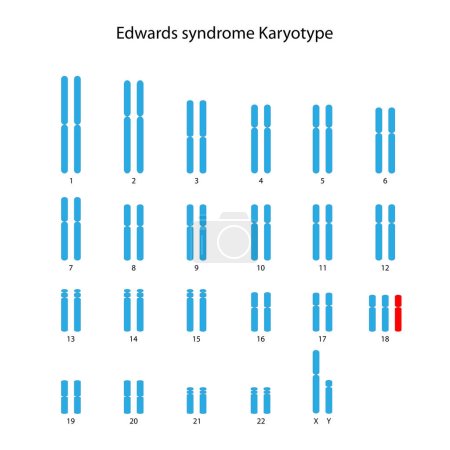 Edwards-Syndrom (Trisomie 18) menschlicher (männlicher) Karyotyp