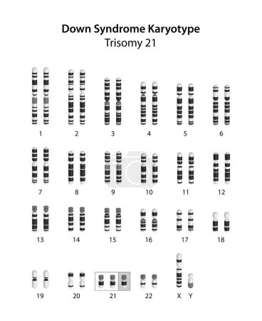 Téléchargez les photos : Syndrome de Down (trisomie 21) caryotype humain - en image libre de droit