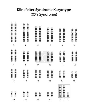 Téléchargez les photos : Caryotype du syndrome de Klinefelter (syndrome de XXY). - en image libre de droit