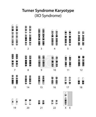 Foto de Síndrome de Turner (X0) cariotipo humano - Imagen libre de derechos