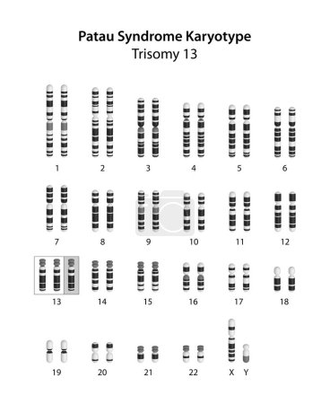 Téléchargez les photos : Syndrome de Patau (trisomie 13) caryotype humain (masculin) - en image libre de droit