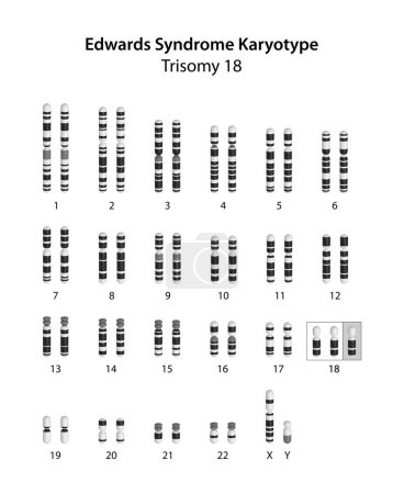 Photo for Edwards syndrome (trisomy 18) human (male) karyotype - Royalty Free Image