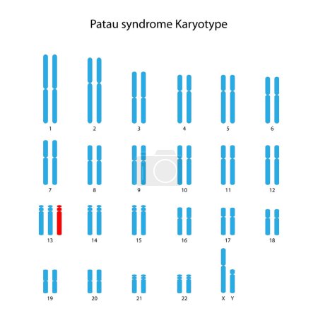 Ilustración de Síndrome de Patau (trisomía 13) cariotipo humano (masculino) - Imagen libre de derechos