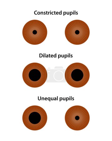 Illustration for Human eye. Constricted, dilated, and unequal pupils. - Royalty Free Image