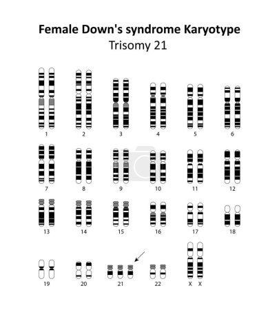 Weibliches Down-Syndrom (Trisomie 21) menschlicher Karyotyp
