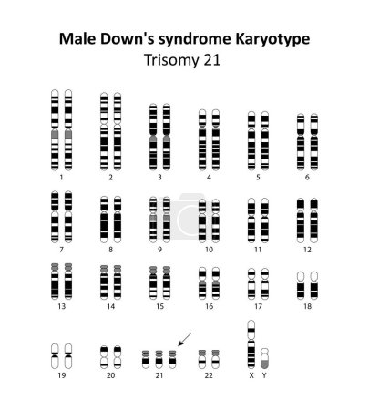 Syndrome de Down masculin (trisomie 21) caryotype humain