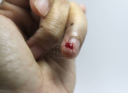 Téléchargez les photos : The ring finger nail that was cut by the knife, with the blood starting to coagulate. - en image libre de droit