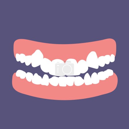 Illustration for Orthodontic teeth problem crowding. Abnormal eruption. Double tooth. Opposite occlusion, open bite, crowded teeth, cavities, dentition. Vector illustration - Royalty Free Image
