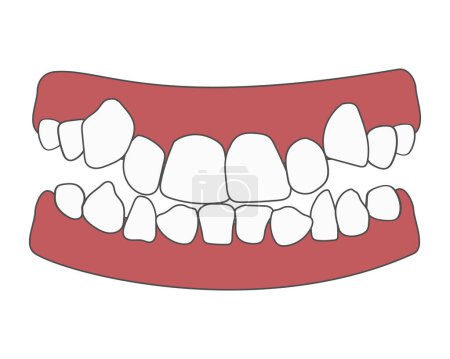 Illustration for Orthodontic problem teeth crowding. Abnormal eruption. Opposite occlusion, open bite, crowded teeth, cavities, dentition. Vector illustration isolated - Royalty Free Image