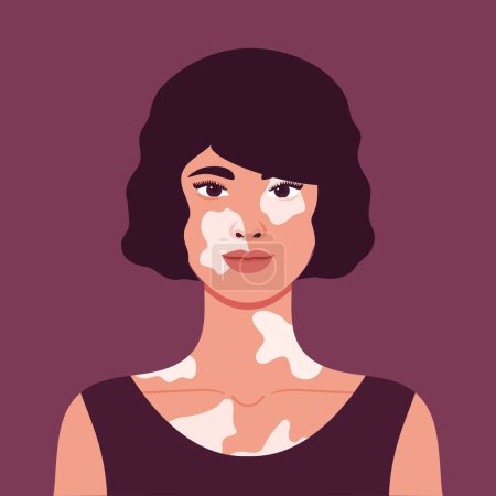 Ilustración de Hermosa joven con despigmentación de vitiligo. Apariencia rara. Retrato o un avatar. Ilustración vectorial - Imagen libre de derechos