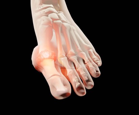 Gout is a common form of inflammatory arthritis on human feet toe finger