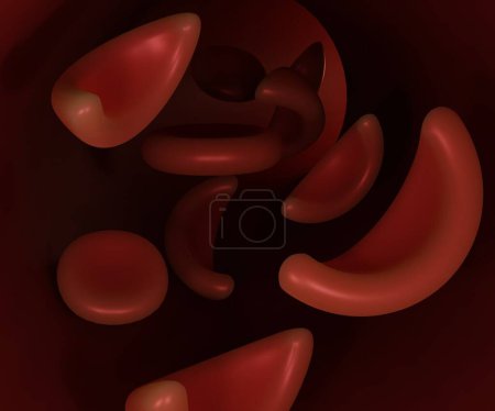 Foto de Anemia de células falciformes, algunos glóbulos rojos parecen hoces utilizados para cortar el trigo 3d renderizado. - Imagen libre de derechos