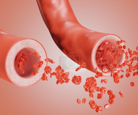 Foto de Vaso sanguíneo normal y ensanchamiento de los vasos sanguíneos, Vasodilatación, también conocido como vasorelaxación, es el ensanchamiento de los vasos sanguíneos 3d renderizado - Imagen libre de derechos