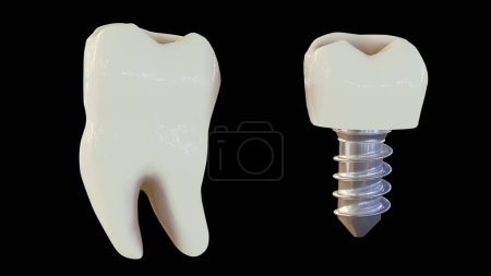 Téléchargez les photos : 3d rendu de la dent humaine saine et implant dentaire dans le fond noir - en image libre de droit