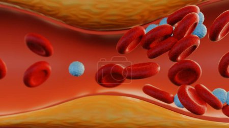 3d representación de la formación de placa de colesterol en la arteria (aterosclerosis)