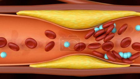 3D-Darstellung der Plaquebildung von Cholesterin in der Arterie (Arteriosklerose))