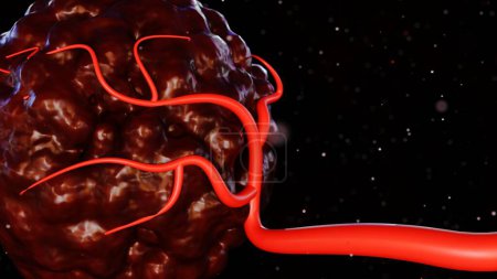 3D-Darstellung von Krebs erfordert eine Blutversorgung, um die Nährstoffe und Sauerstoff zu liefern, die es braucht, um zu wachsen und zu überleben