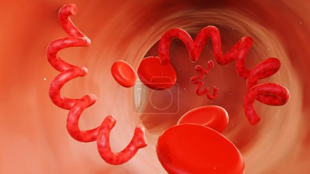 3D-Darstellung der kardiovaskulären Syphilis bezieht sich auf die Infektion des Herzens und verwandter Blutgefäße durch die Syphilis-Bakterien