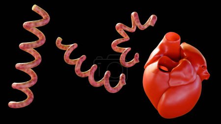 3D-Darstellung der kardiovaskulären Syphilis bezieht sich auf die Infektion des Herzens und verwandter Blutgefäße durch die Syphilis-Bakterien