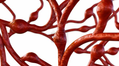 Foto de 3d renderización de microaneurismas (AM), estas son pequeñas inflamaciones de los vasos sanguíneos en la retina - Imagen libre de derechos