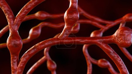 Foto de 3d renderización de microaneurismas (AM), estas son pequeñas inflamaciones de los vasos sanguíneos en la retina - Imagen libre de derechos