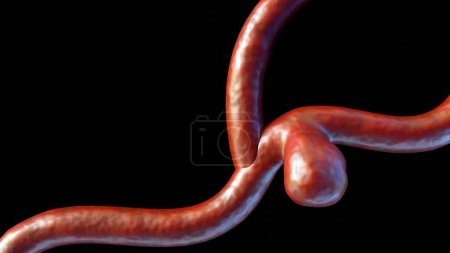 Foto de La representación 3d de un aneurisma sacular, también conocido como aneurisma de la baya, es un bulto que se forma en la pared de un vaso sanguíneo en el cerebro - Imagen libre de derechos