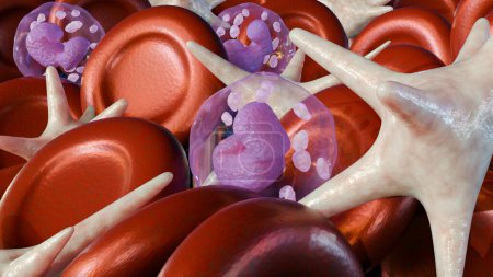 Eine 3D-Darstellung des Blutgerinnsels, das in einen anderen Teil des Körpers wandert, wird als Embolus bezeichnet