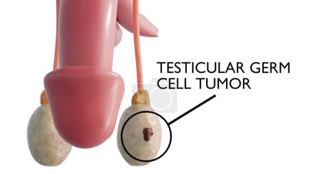 3D Rendering of Testicular cancer happens when cells in the testicle grow to form a tumor