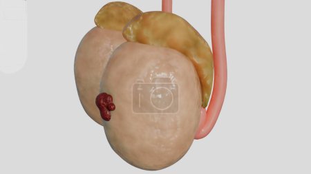 Téléchargez les photos : 3D Rendering of Testicular cancer happens when cells in the testicle grow to form a tumor - en image libre de droit