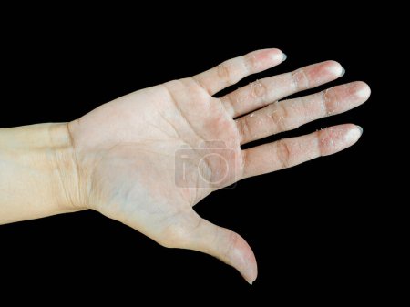 Photo for Xerosis on hand. The medical term for dry skin. Isolated black background. - Royalty Free Image