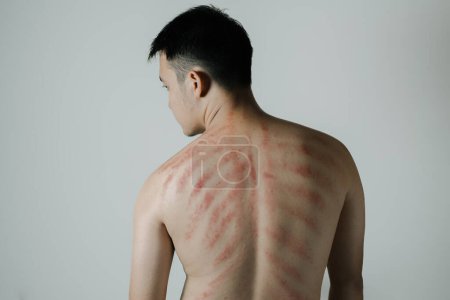Photo for Red marks from scraped coin on a man's back. Javanese traditional alternative non-medical treatment to treat symptoms of colds called Kerokan. - Royalty Free Image