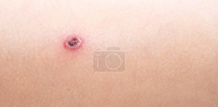 The child has spotted red pimples and a blistering rash from chickenpox or the varicella zoster virus. Viral disease in children. Red pimples all over the body. Infection.