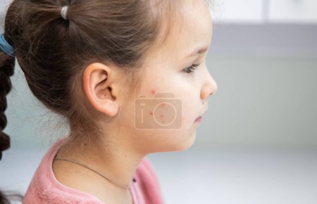 La varicelle chez un enfant. La fille a des boutons rouge vif sur les joues et le cou. Maladie virale. Éruption cutanée chez un enfant.