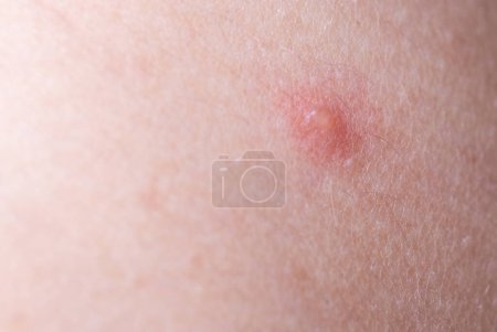 The child has spotted red pimples and a blistering rash from chickenpox or the varicella zoster virus. Viral disease in children. Red pimples all over the body. Infection.