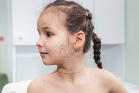 La varicelle chez un enfant. La fille a des boutons rouge vif sur les joues et le cou. Maladie virale. Éruption cutanée chez un enfant.