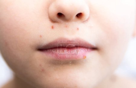 Chickenpox in a child. The girl has bright red pimples on her cheeks and neck. Viral disease. Rash in a child.