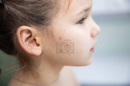 Chickenpox in a child. The girl has bright red pimples on her cheeks and neck. Viral disease. Rash in a child.
