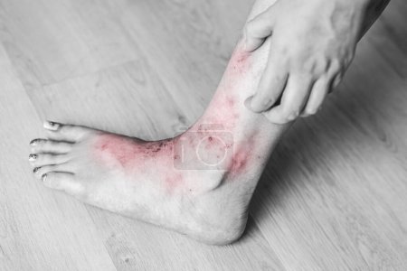 Photo for Severe leg itching scratching. scary wound Itchy rash, allergies, fungal skin diseases - Royalty Free Image