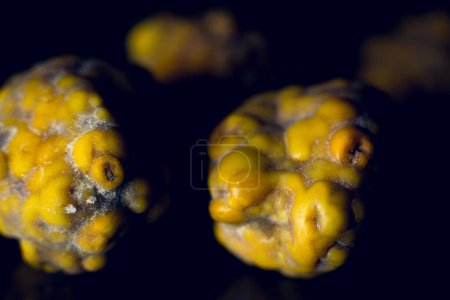 Photo for Gallstones,multiple cholesterol stone in gallbladder with cholecystitis. Gallbladder disease, stone formation. Cholecystectomy vs Laparoscopic Gallbladder Surgery for gallstones removal. - Royalty Free Image