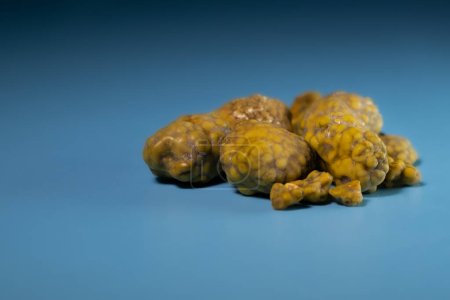 Photo for Gallstones, multiple cholesterol stone in gallbladder with cholecystitis. Gallbladder disease, stone formation. Cholecystectomy vs Laparoscopic Gallbladder Surgery for gallstones removal. - Royalty Free Image