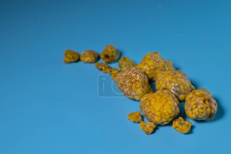 Photo for Gallstones, multiple cholesterol stone in gallbladder with cholecystitis. Gallbladder disease, stone formation. Cholecystectomy vs Laparoscopic Gallbladder Surgery for gallstones removal. - Royalty Free Image