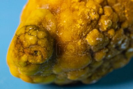 Photo for Gallstones,multiple cholesterol stone in gallbladder with cholecystitis. Gallbladder disease, stone formation. Cholecystectomy vs Laparoscopic Gallbladder Surgery for gallstones removal. - Royalty Free Image