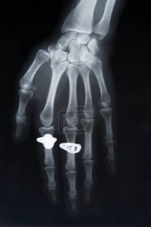 Téléchargez les photos : Image radiographique de la main avec deux anneaux - en image libre de droit