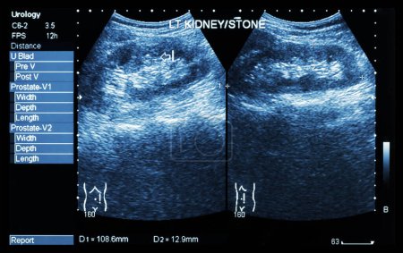 Foto de Ecografía del riñón: mostrar cálculos renales izquierdos (2 imágenes para comparar - Imagen libre de derechos
