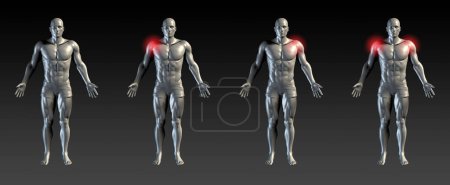 Foto de 3d renderizado del cuerpo humano con músculos, lesión en el hombro - Imagen libre de derechos