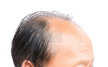 Téléchargez les photos : Gros plan vieil homme grave problème de perte de cheveux - en image libre de droit