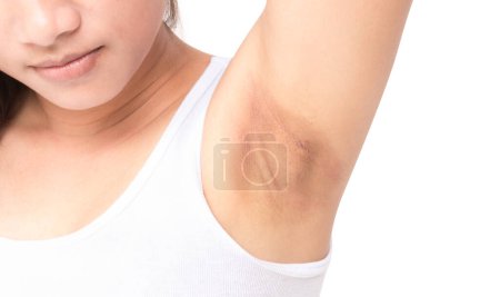 Photo for Female problem black armpit on white background for skin care - Royalty Free Image