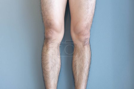 Foto de Primer plano piernas hombres piel y peludo para el cuidado de la salud concepto - Imagen libre de derechos