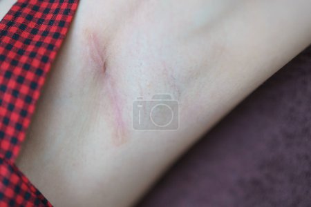 Photo for Keloids on the armpit after breast surgery. - Royalty Free Image